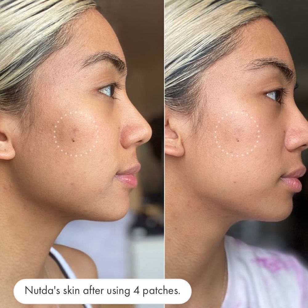 Hero Cosmetics Mighty Patch for Dark Spots - Picture 4 of 5
